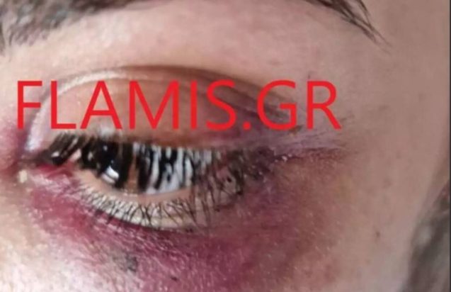 Πάτρα: Ξυλοδαρμός 31χρονης