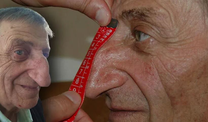 Πέθανε ξαφνικά ο άνθρωπος με την μακρύτερη μύτη στον κόσμο