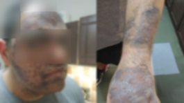 Καυτό λάδι έπεσε σε εργαζόμενο στην Κρήτη