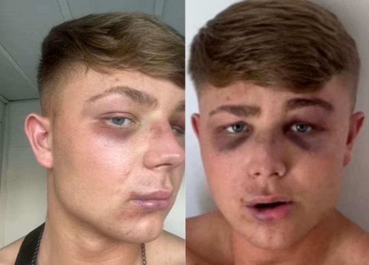 Ζάκυνθος: Με έστειλαν στο νοσοκομείο για μία selfie – Τι καταγγέλλει ο Βρετανός τουρίστας που ξυλοκοπήθηκε από μπράβους