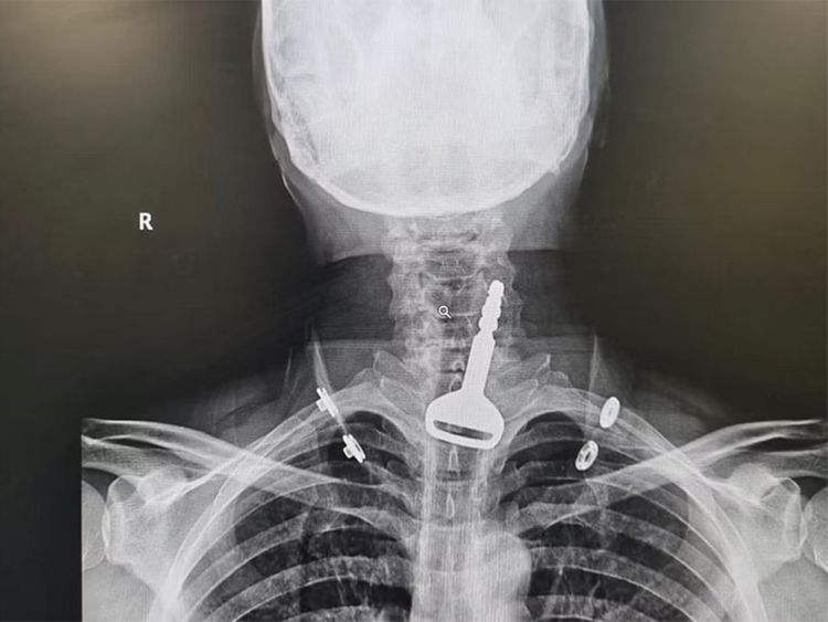 Κατάπιε το κλειδί του αυτοκινήτου του και παραλίγο να πνιγεί