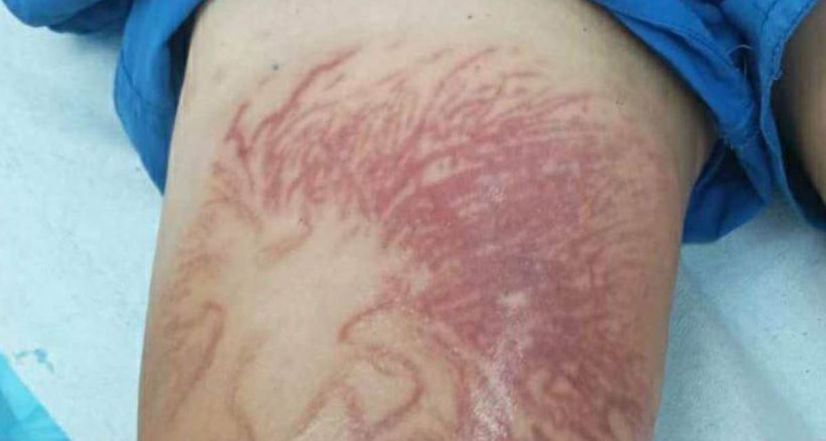 τσίμπημα θαλάσσια ανεμώνη