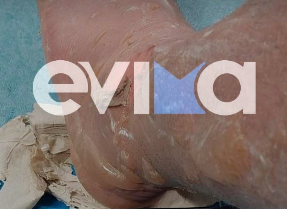 Εύβοια έκρηξη Ηλεκτρικής σκούπας