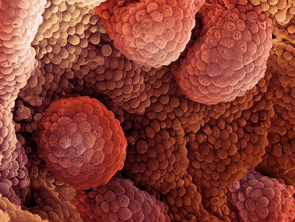 Νέα μελέτη αποκαλύπτει τον μηχανισμό με τον οποίο όγκοι του νευρικού συστήματος μετατρέπονται σε κακοήθεια