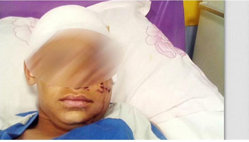 Αρτέμιδα: Ο 11χρονος που δέχτηκε επίθεση από πίτμπουλ