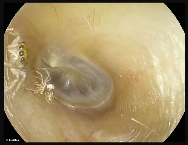 Γιατροί βρήκαν αράχνη στο αυτί γυναίκας – Ζούσε εκεί… για 4 ημέρες