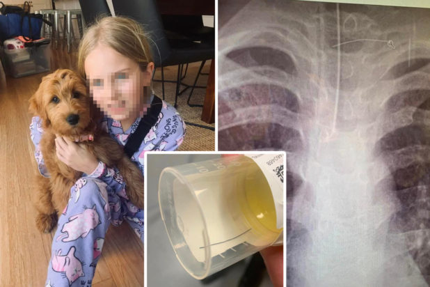 Πρωινό παραλίγο να σκοτώσει κορίτσι – Τρύπησε τον οισοφάγο της