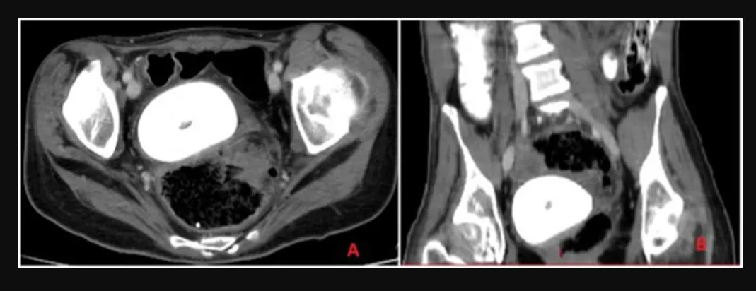 Γιατροί αφαίρεσαν σπάνια «πέτρα του κόλπου» σε μέγεθος πορτοκαλιού από τη λεκάνη μιας γυναίκας