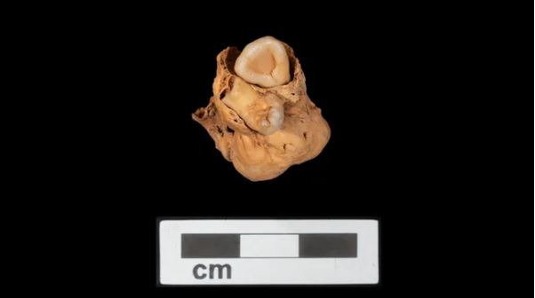 Σπάνιος όγκος με δόντια, ανακαλύφθηκε σε τάφο ηλικίας 3.000 ετών