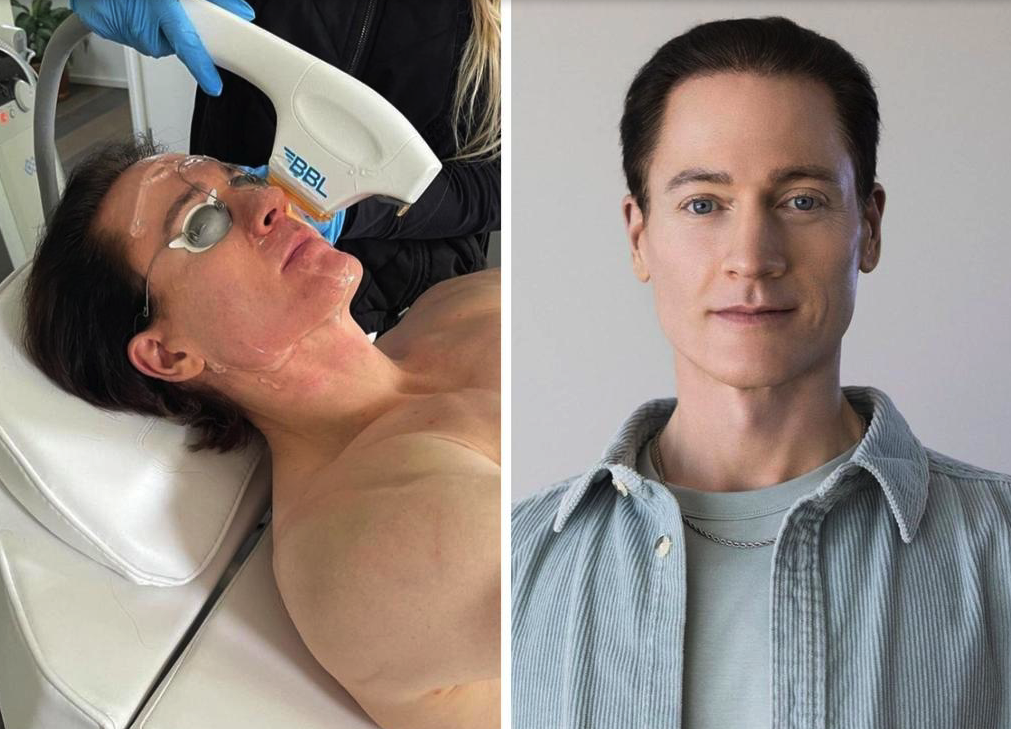 Bryan Johnson: Υποβάλλεται σε νέα πειραματική γονιδιακή θεραπεία για να νικήσει τον χρόνο – «Θα ζήσω μέχρι τα 200»