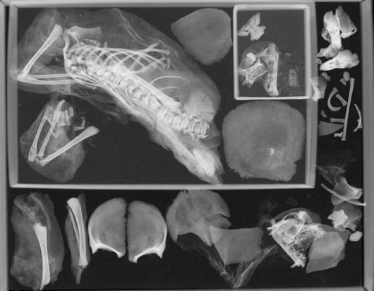 Το δεύτερο έμβρυο που ανακαλύφθηκε στον θώρακα της έφηβης δημιούργησε ερωτήματα