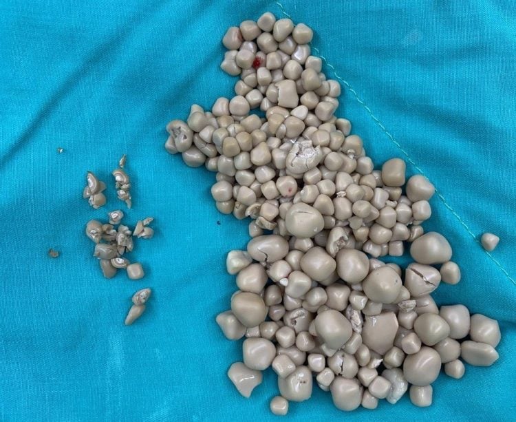 Άφωνοι οι γιατροί με τις πέτρες που βρήκαν στον νεφρό 20χρονης –  Δεν έπινε καθόλου νερό, μόνο χυμούς και τσάι