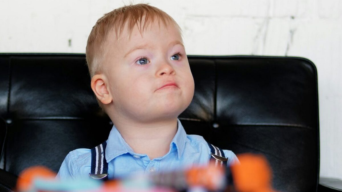 Εντοπίστηκε η πρώτη γνωστή περίπτωση συνδρόμου Down κατά την αρχαιότητα στην Ελλάδα