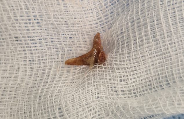 Χανιά: Είχε κόκκαλο από κουνέλι στον πνεύμονά της