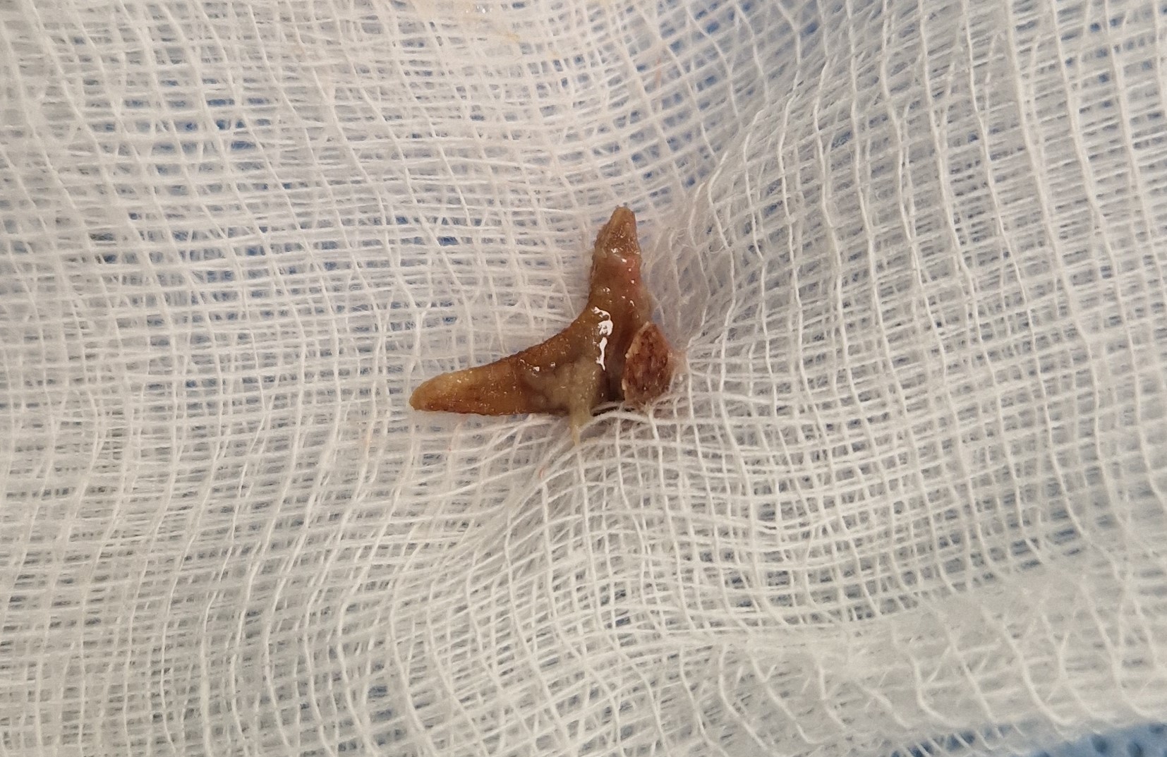 Χανιά: Είχε κόκκαλο από κουνέλι στον πνεύμονά της