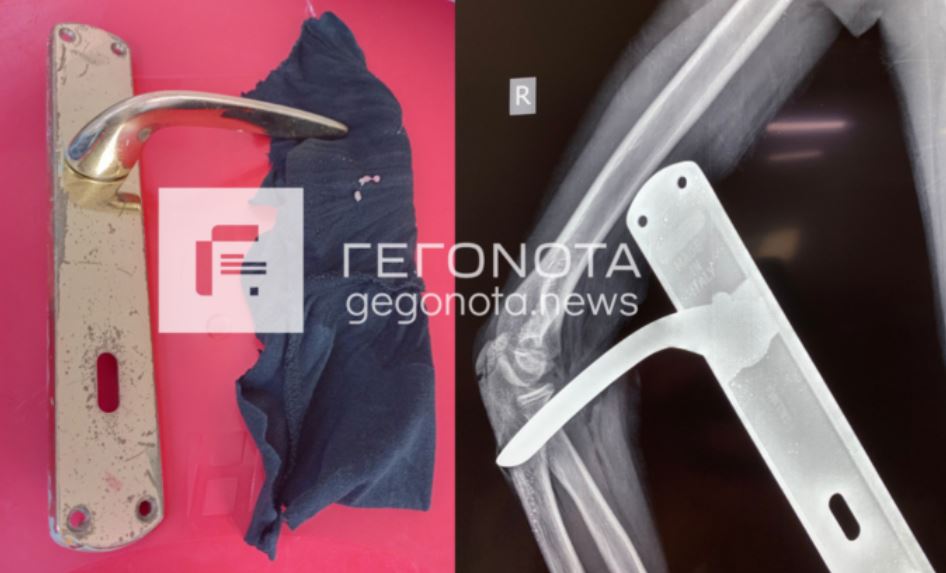 Βόλος: Πόμολο καρφώθηκε στο χέρι 11χρονου μαθητή – Υποβλήθηκε σε επέμβαση