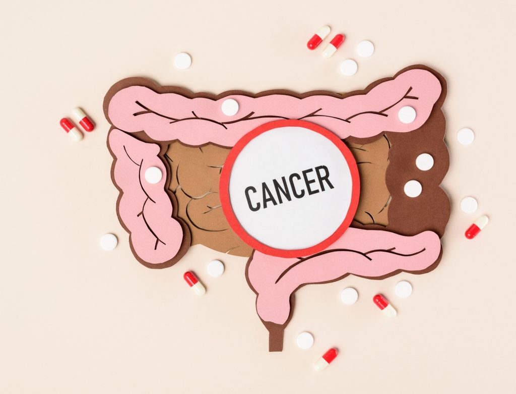 Καρκίνος του παχέος εντέρου