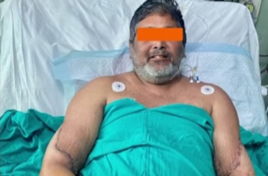 Ινδία: Άνδρας έχει πλέον γυναικεία χέρια ύστερα από σπάνια διπλή μεταμόσχευση