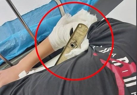 Βόλος: Πώς «καρφώθηκε» το πόμολο στο χέρι του 13χρονου μαθητή – «Η αντίδρασή του ήταν πολύ γενναία»