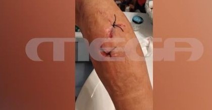 Ραφήνα: «Με έριξαν κάτω και με δάγκωσαν στο αυτί, τα έχουν ξαναδεί στην πλατεία» λέει η γυναίκα που της επιτέθηκαν σκυλιά