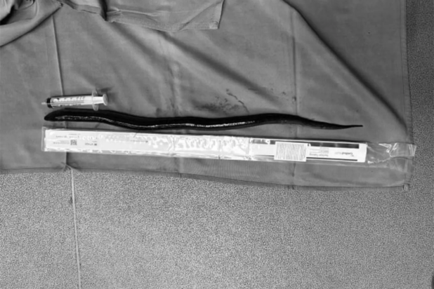 Οι γιατροί έμειναν με το στόμα ανοιχτό: Βρήκαν ζωντανό χέλι 30 εκατοστών στην κοιλιά άνδρα