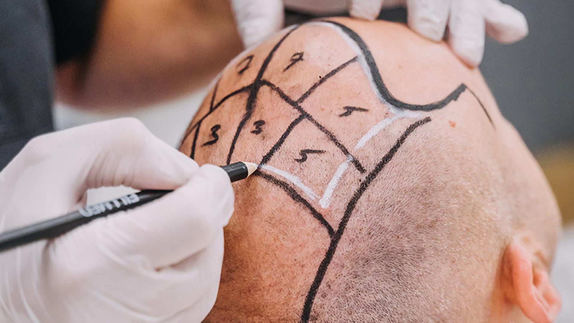 Εμφύτευση μαλλιών σε ιατρείο για αφροδίσια νοσήματα – «Τους τσίμπησε» η ΕΑΔ