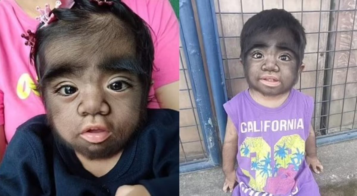 Παιδί – λυκάνθρωπος έκανε την μητέρα του να φοβάται για κατάρα – Το σπάνιο σύνδρομο από το οποίο πάσχει