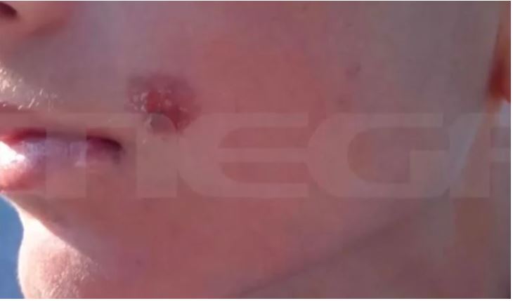 Πέλλα: 15χρονος επιτέθηκε σε 14χρονο και τού έσβησε αναμμένο τσιγάρο