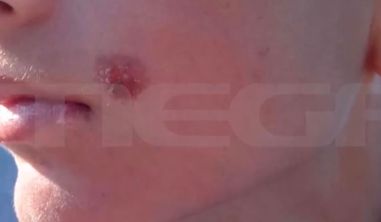 Πέλλα: «Μου πάτησε το τσιγάρο στο μάγουλο, έπεσα κάτω από τον πόνο» λέει ο 14χρονος – Καταγγέλλει επιθέσεις από συμμαθητές του