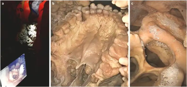 α) ο εξοπλισμός Olympus - στην οθόνη είναι ορατός ο δεξιός ακουστικός πόρος του Νεάντερταλ- β) η υπερώα αποκτήθηκε με τη διέλευση του καθετήρα στο μικρό χώρο πάνω από την υπερώα και δείχνει τη σχεδόν τέλεια διατήρηση του δείγματος. γ) ένας σπόνδυλος που έχει κολλήσει μέσα στο οστικό σύνολο, στην κόγχη, δεν είναι ορατός από πάνω 
