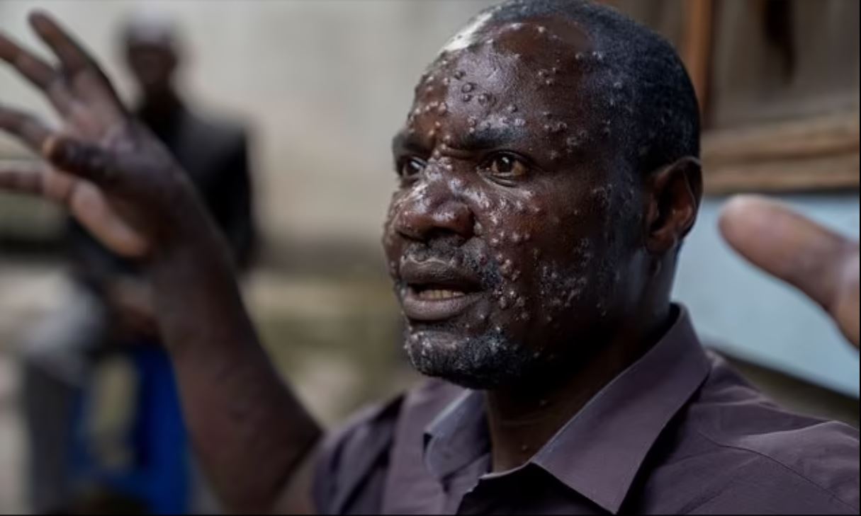 Ευλογιά: Νέα θανατηφόρα παραλλαγή μεταδίδεται αστραπιαία – Τα συμπτώματα και η θνησιμότητα