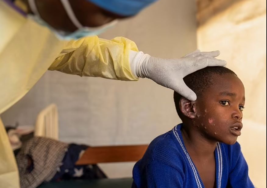 Κίνα: Προληπτικά μέτρα για ταξιδιώτες και εμπορεύματα από χώρες που επιβεβαιώθηκαν κρούσματα της mpox