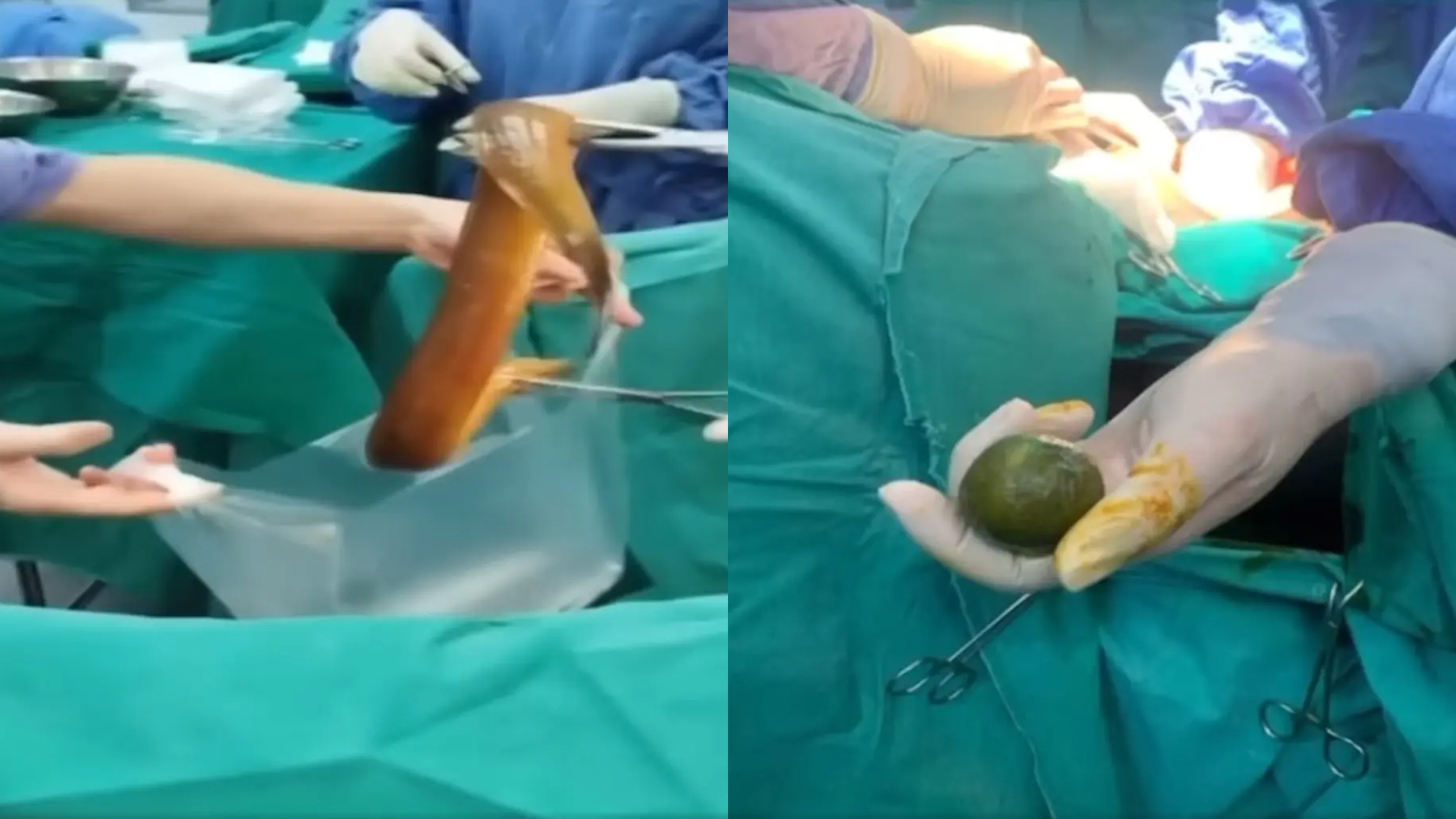 Άφωνοι οι γιατροί: Πήγε στο νοσοκομείο με έντονους πόνους στην κοιλιά και αφαίρεσαν από μέσα του… ένα ζωντανό χέλι