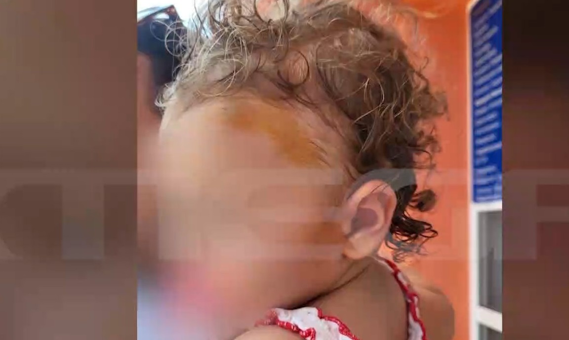 Πρέβεζα επίθεση σκύλου παιδί