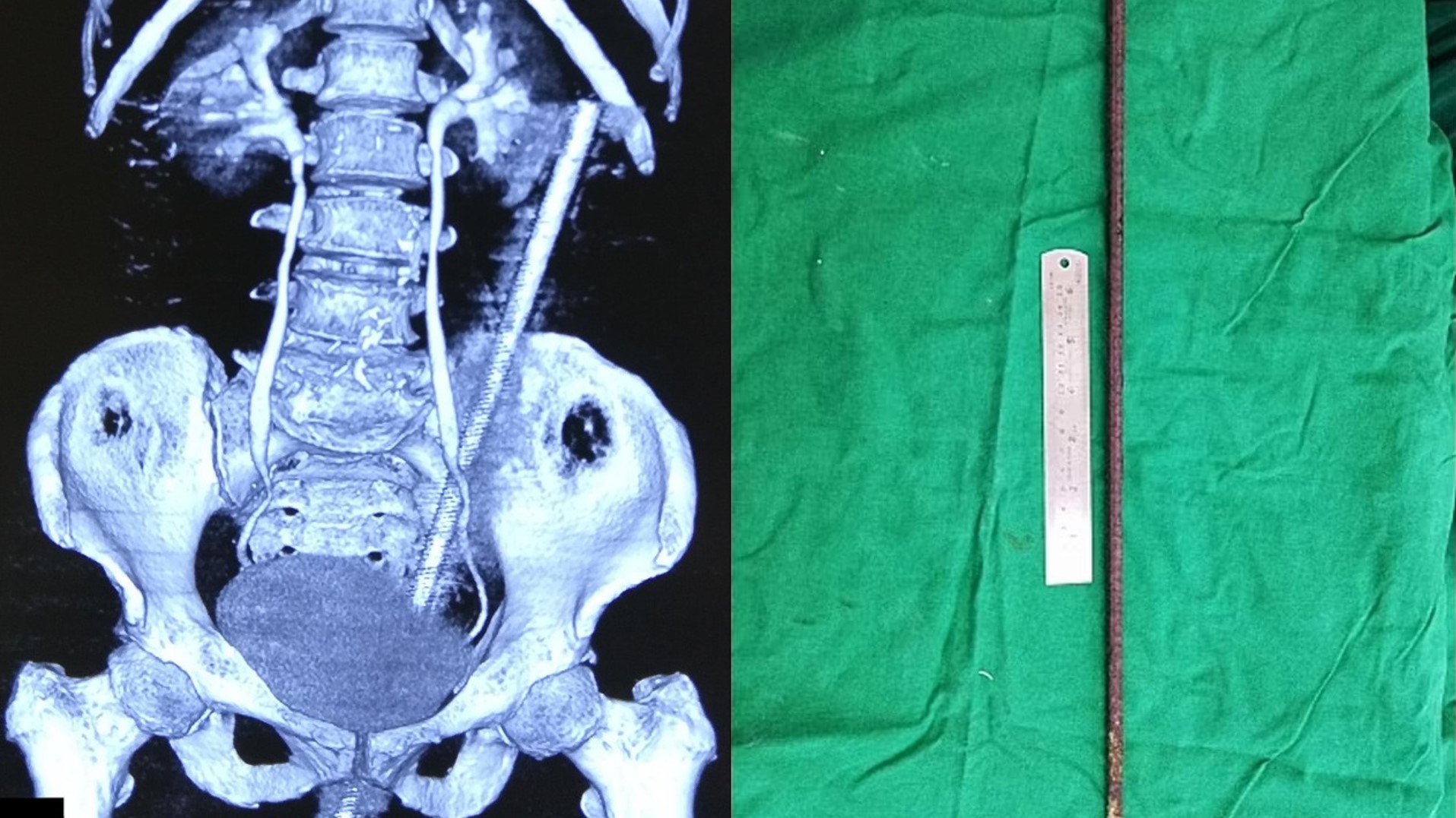 Ατύχημα σοκ: Σιδερένια βέργα διαπέρασε το σώμα 65χρονης – Γλίστρησε και έπεσε