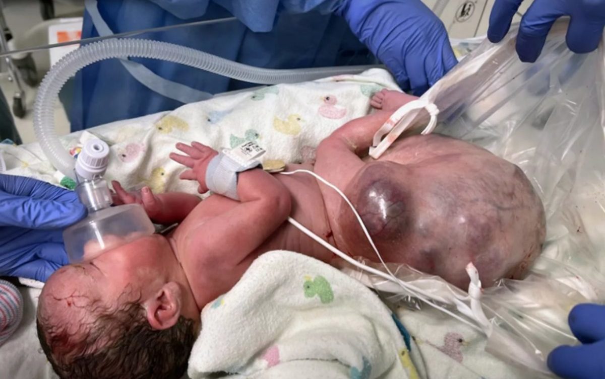 Μωρό γεννήθηκε με όγκο σχεδόν 2 κιλών στην «ουρά» – «Το είδα στον υπέρηχο και ήταν τρομακτικό»