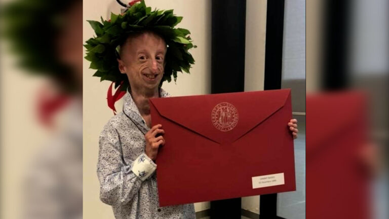 Ιταλία: Πέθανε ο Σάμι Μπάσο που έπασχε από προγηρία – Έζησε περισσότερο από κάθε άλλο ασθενή με το ίδιο σύνδρομο