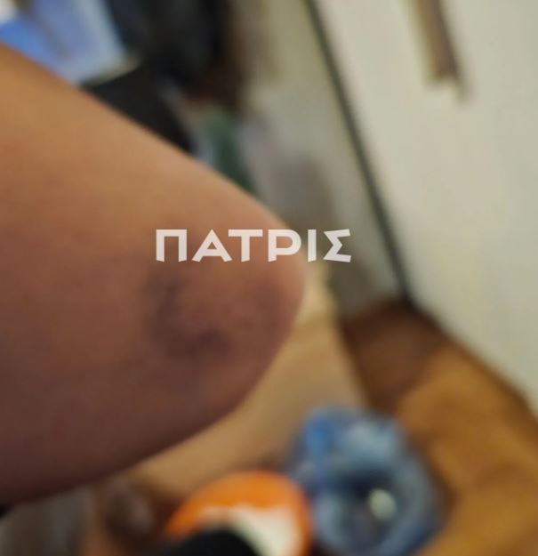Έδεσσα: 29χρονη πήγε για διακοπές με τον σύντροφο της και έζησε τον απόλυτο εφιάλτη – Την ξυλοκόπησε βάναυσα και την παράτησε στον δρόμο