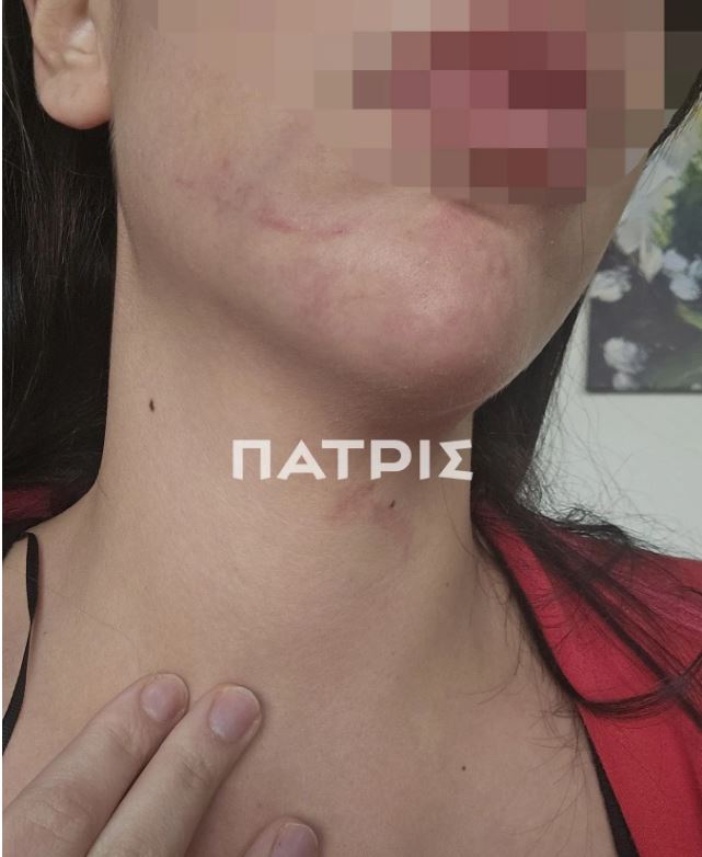 Έδεσσα: 29χρονη πήγε για διακοπές με τον σύντροφο της και έζησε τον απόλυτο εφιάλτη – Την ξυλοκόπησε βάναυσα και την παράτησε στον δρόμο