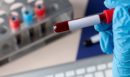 ΕΚΠΑ: Τι είναι η θεραπευτική πλασμαφαίρεση;
