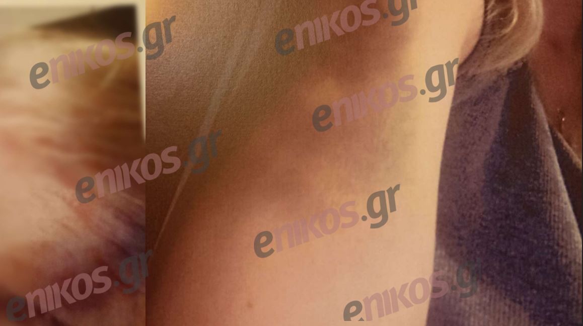 Καβάλα: Αξιωματικός της Πυροσβεστικής ξυλοκόπησε άγρια την σύζυγό του – «Αν δεν έμπαινε το παιδί στη μέση, δεν ξέρω αν θα ζούσα»