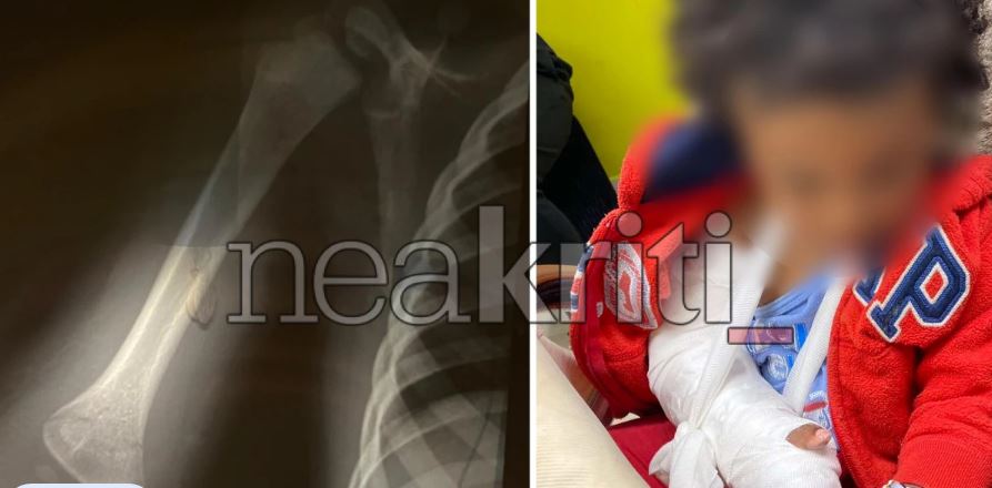 Νοσοκομείο Ρεθύμνου: Έδιωξαν νήπιο με σπασμένο χέρι χωρίς να το εξετάσουν – ΕΔΕ μετά την καταγγελία της μητέρας του