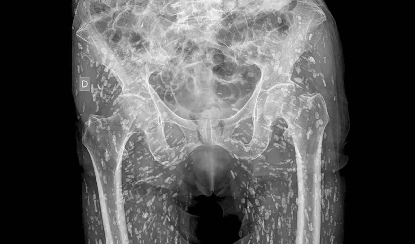 Ακτινογραφία – σοκ: Ανακάλυψε ότι το σώμα του ήταν γεμάτο με αυγά από παράσιτα – Το λάθος που είχε κάνει στην κουζίνα