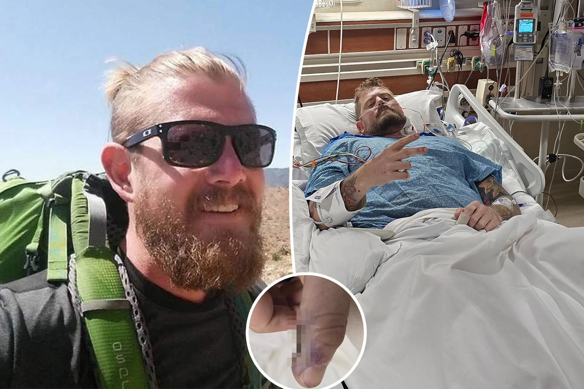 Άνδρας ακρωτηριάστηκε και στα δύο πόδια έπειτα από ένα κάψιμο στον αντίχειρά του –  «Ένα ταξίδι που κατέληξε σε εφιάλτη»