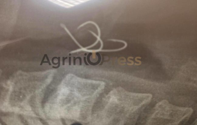 Αγρίνιο: Έφαγε χταπόδι και του κόλλησε στο λαιμό… αγκίστρι