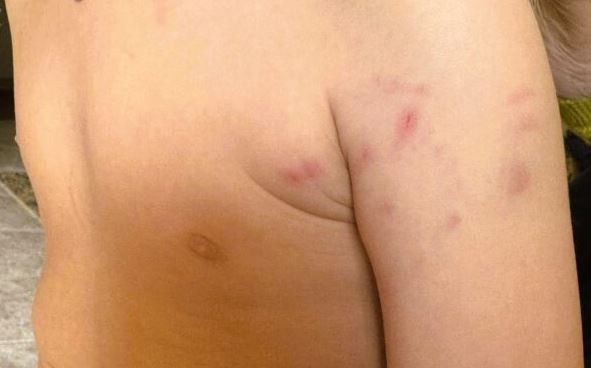 Επίθεση αδέσποτου σκύλου σε παιδί στο Αιτωλικό – Μεταφέρθηκε τραυματισμένο στο νοσοκομείο