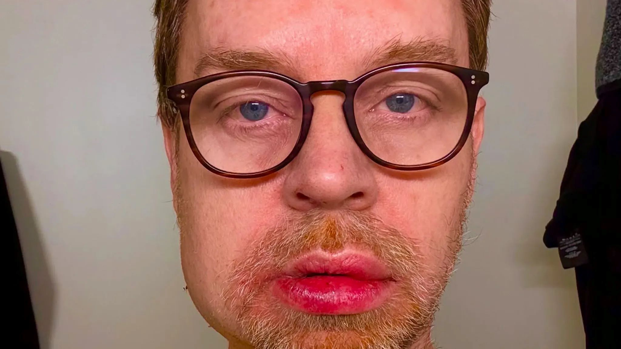 Darren Hayes: «Θα μπορούσα να είχα πεθάνει» – Το σοβαρό ατύχημα του πρώην τραγουδιστή των Savage Garden