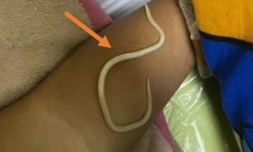 Ινδονησία: Γιγαντιαία σκουλήκια αφαίρεσαν από το σώμα παιδιού οι γιατροί – Πώς μπήκαν στον οργανισμό του