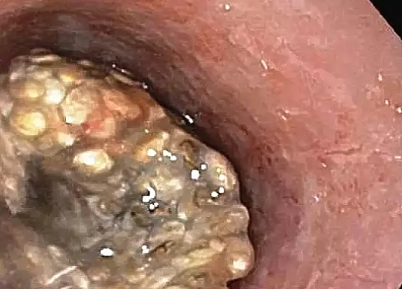 Σοκ: Έφραξε ο οισοφάγος άνδρα μετά την κατανάλωση μίας κοινής υπερτροφής