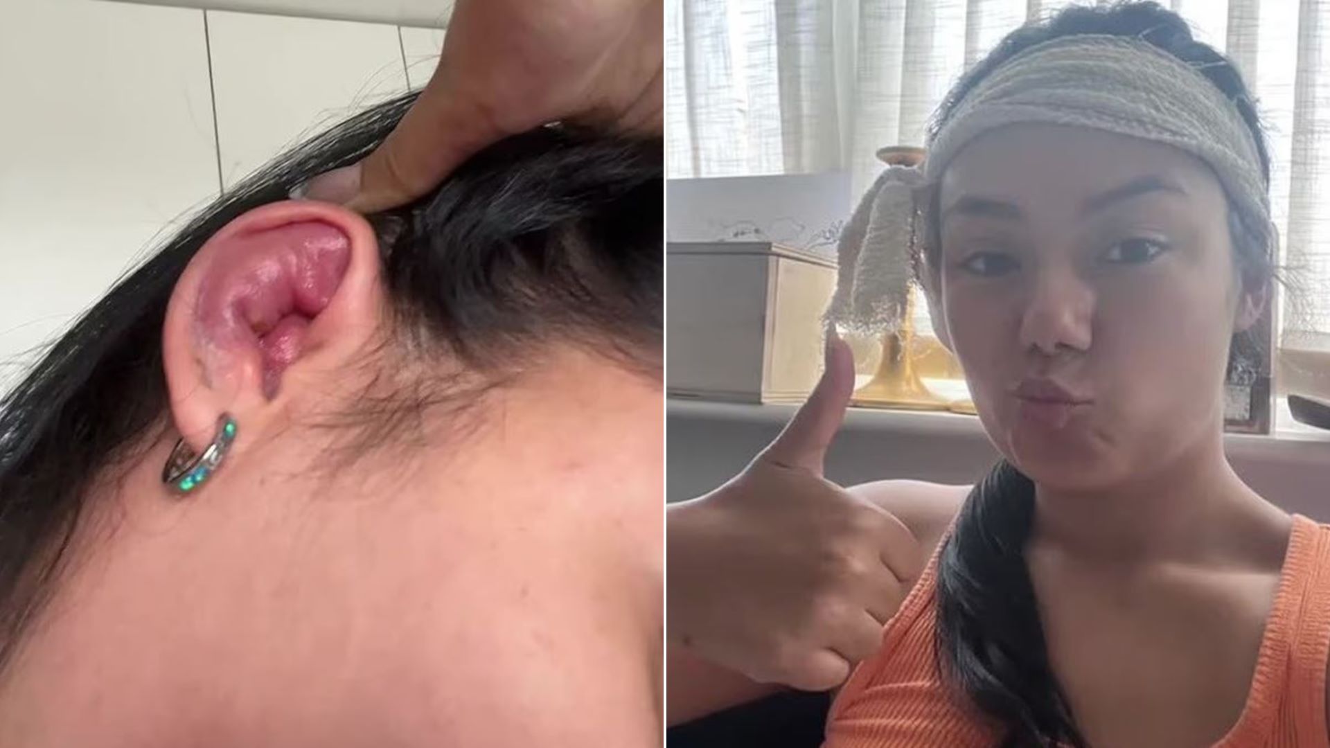 Ρόδος: Αράχνη τσίμπησε τουρίστρια σε ξενοδοχείο και κινδύνευσε να χάσει το αυτί της – «Οι διακοπές έγιναν εφιάλτης»